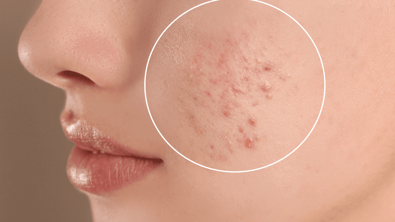 Acne Facial Treatment Queens NY – Clear Your Skin with Targeted Care
