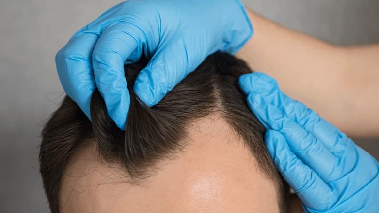 Hair Transplant Turkey: Restore Confidence with Expert Surgeons