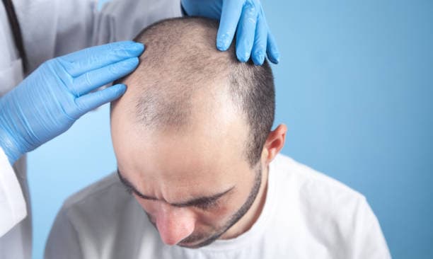 Hair Transplant Price Factors: Technique, Grafts &amp; Surgeon