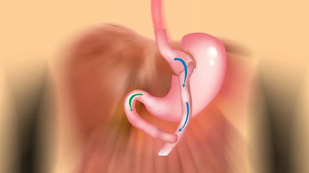 Gastric Sleeve Best Clinic Turkey – Offering Expert Surgeons and All-Inclusive Medical Packages