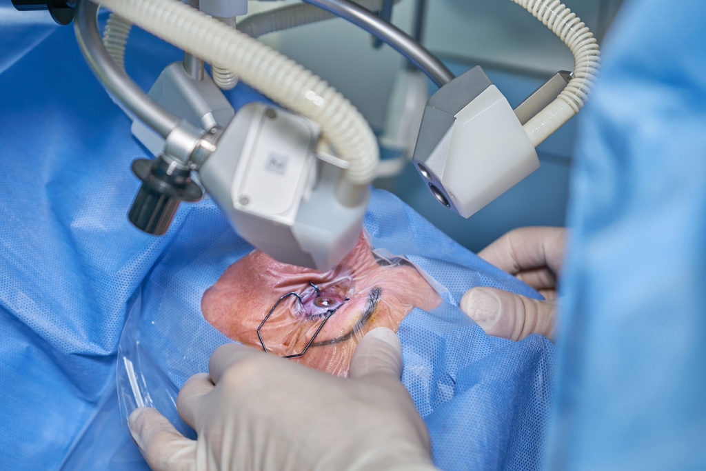 LASIK Istanbul Procedure: How It Works