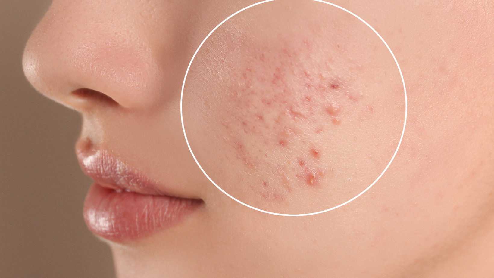 Acne Facial Treatment Queens NY – Clear Your Skin with Targeted Care